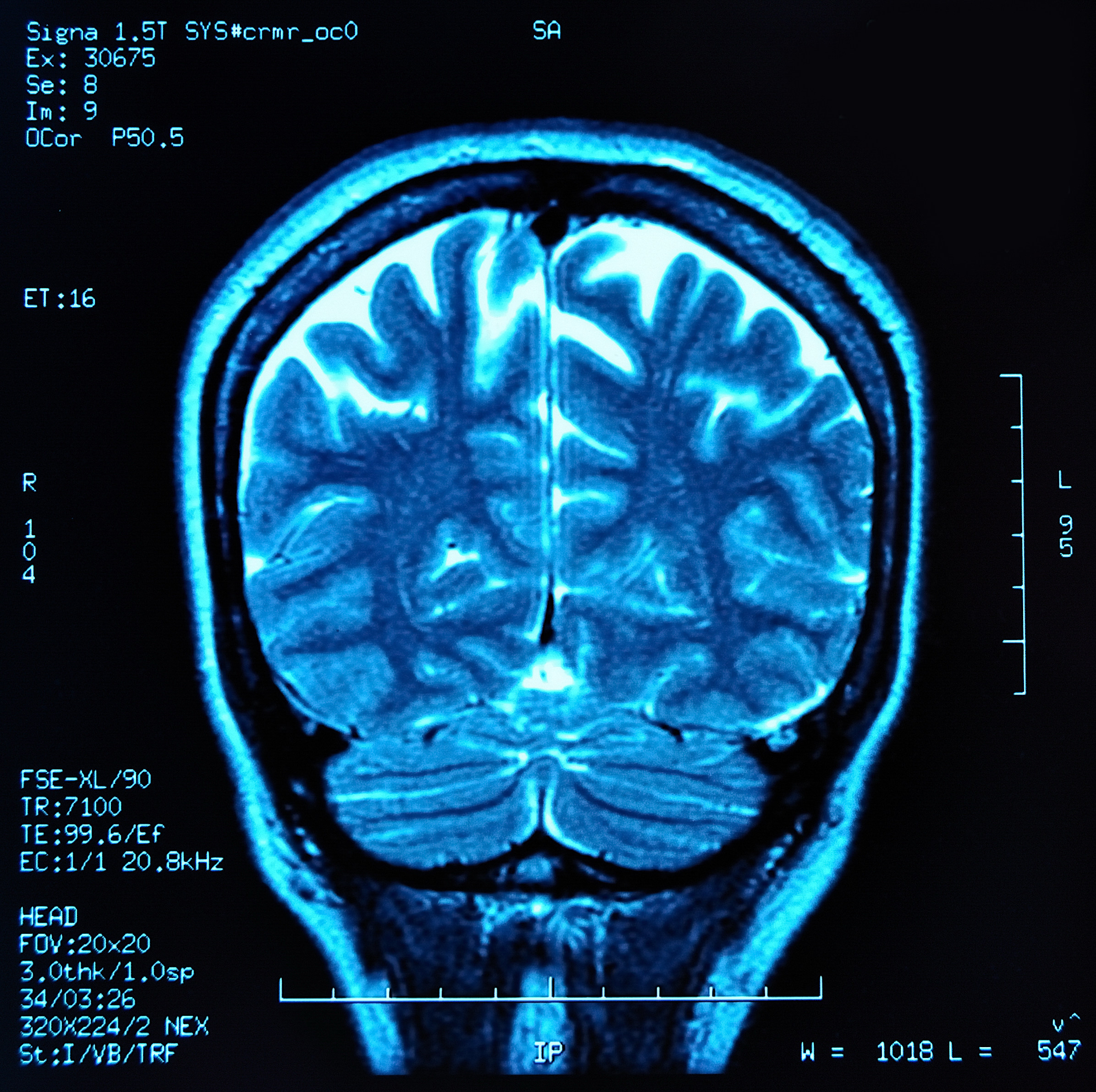 Rmn cerebral - iRM - Investigatii de inalta performanta pentru tine!