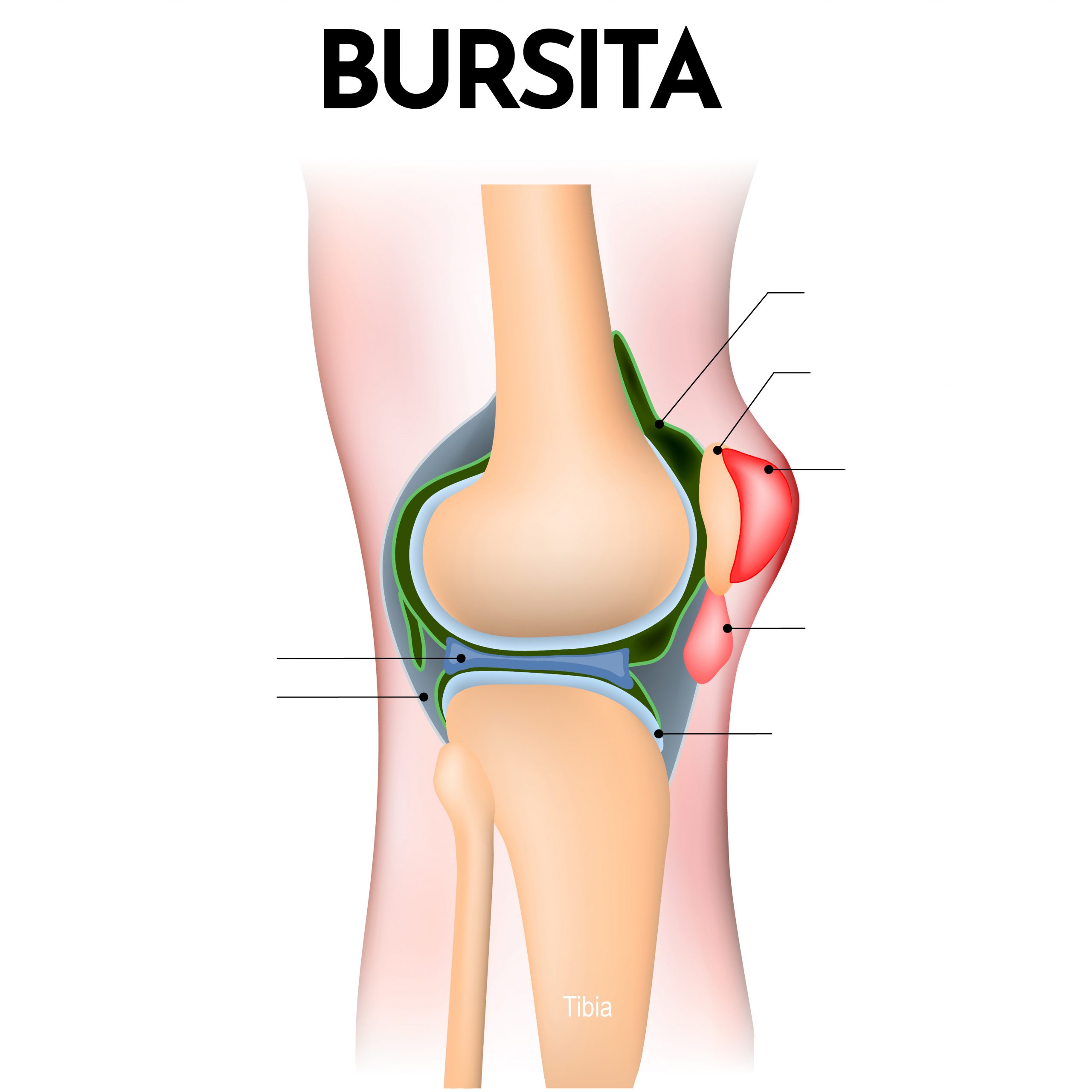 care este tratamentul pentru bursita articulației genunchiului medicamente injectate în articulația genunchiului