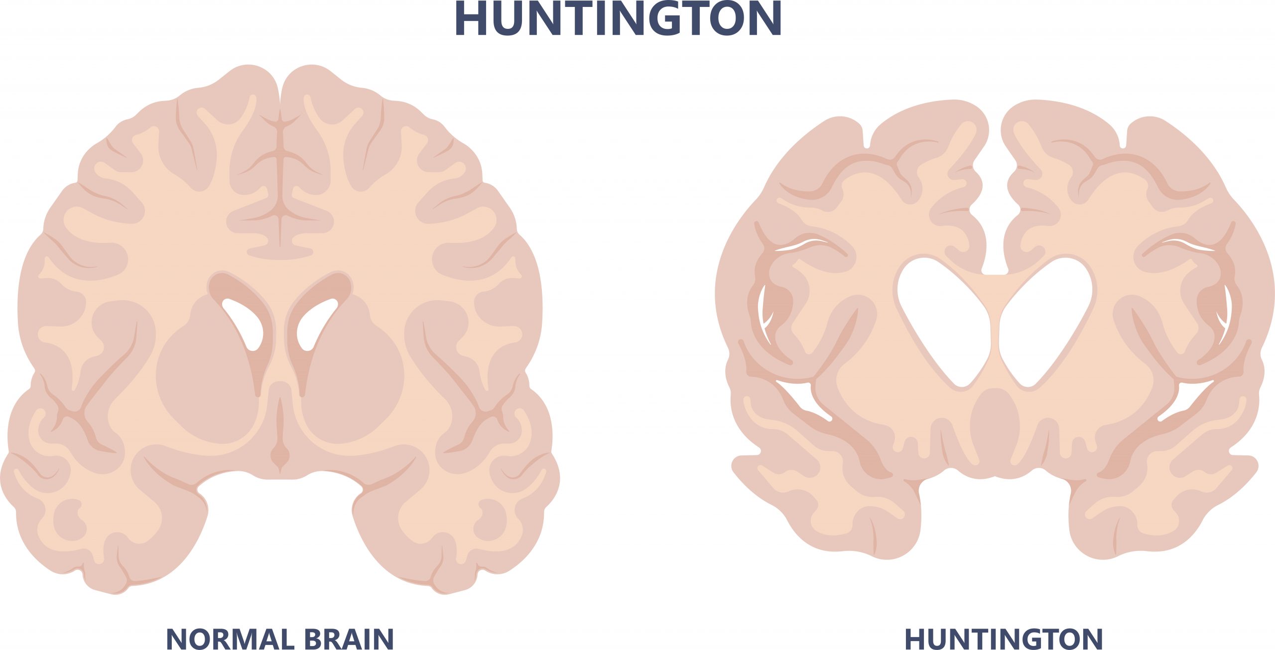 Huntington - iRM - Investigatii de inalta performanta pentru tine!