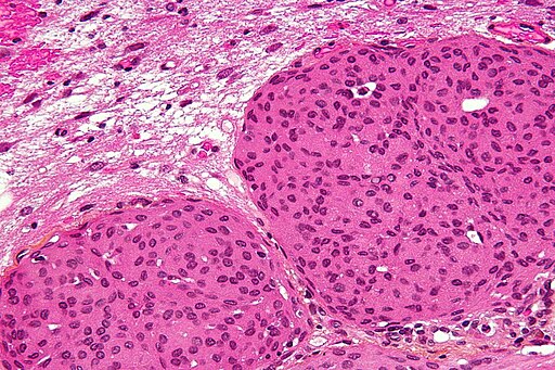 meningiom histopatologie meningiom