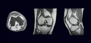 RMN genunchi, planurile axial, coronal si sagital. (in  rezonanta magnetica nucleara)