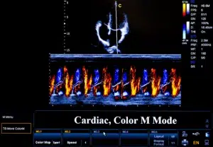 Ecografia cardiacă reprezintă o investigație standard în diagnosticul bolilor cardiace și poate fi utilizată pentru evaluarea unei game variate de afecțiuni cardiovasculare, cum ar fi insuficiența cardiacă, cardiomiopatiile, anomalii congenitale ale inimii, pericarditele, valvulopatiile, trombozele cardiace și stenozele arterelor coronare. Imaginile obținute în timpul examinării ecografice pot oferi medicului informații detaliate despre anatomia și funcția inimii, precum și despre fluxul sanguin în diferite zone ale acesteia.

