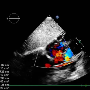flutter atrial