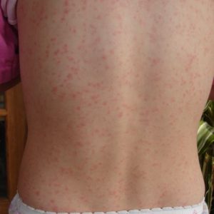 scarlatina, complicatii cardiace in scarlatina