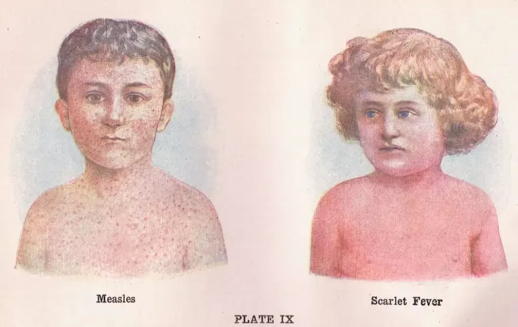 scarlatina la copii pojar vs. scarlatina imagini,scarlatina poze limba, eruptie scarlatina poze, poze scarlatina copii, bube scarlatina, poze cu scarlatina copii