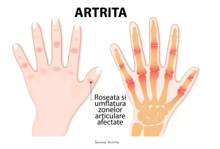 Artrita