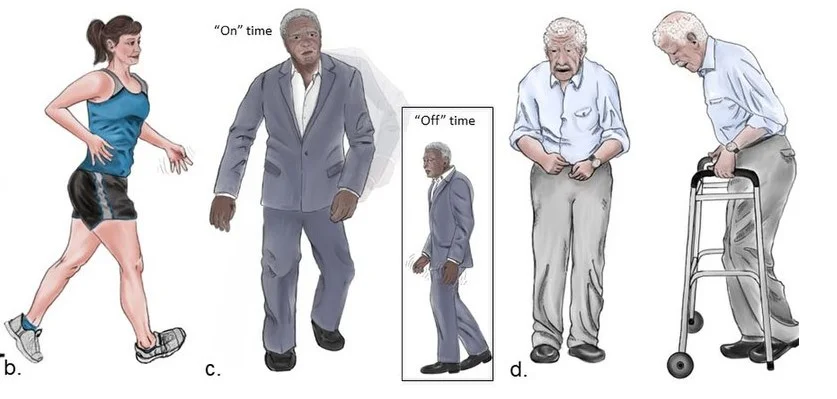 parkinson Boala Parkinson