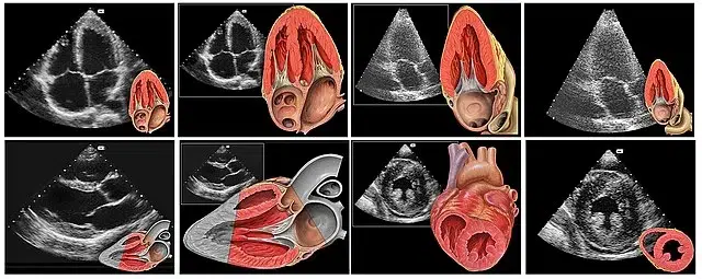 ecocardiografie,ecocardiografie Bucuresti imagini-ecocardiografie