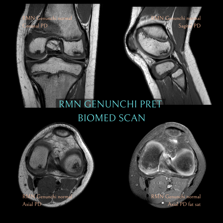 rmn genunchi pret normal plan coronal, sagital, axial