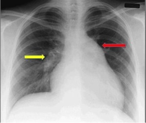 Diagnostic Hipertensiune Pulmonara (HAP)