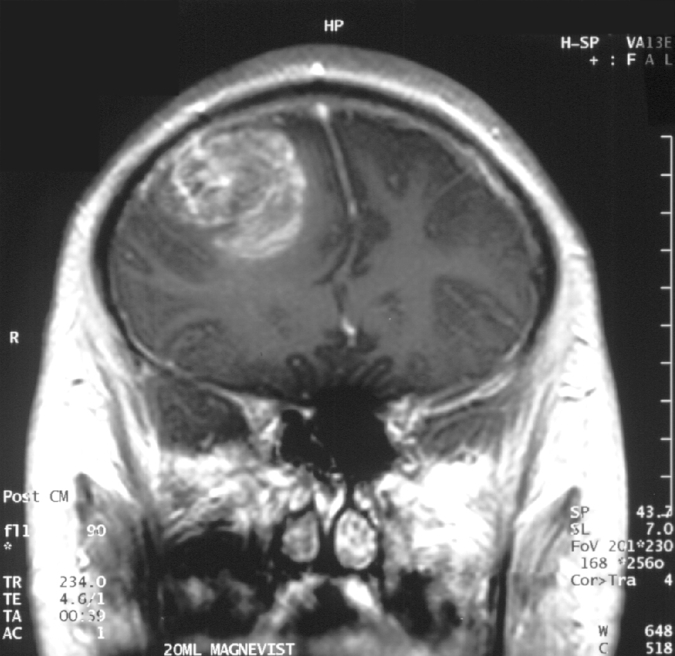 Meningiom